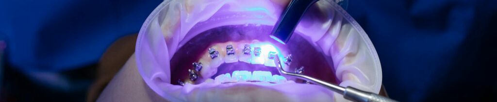 UV light curing dental procedure for teeth whitening and health care.